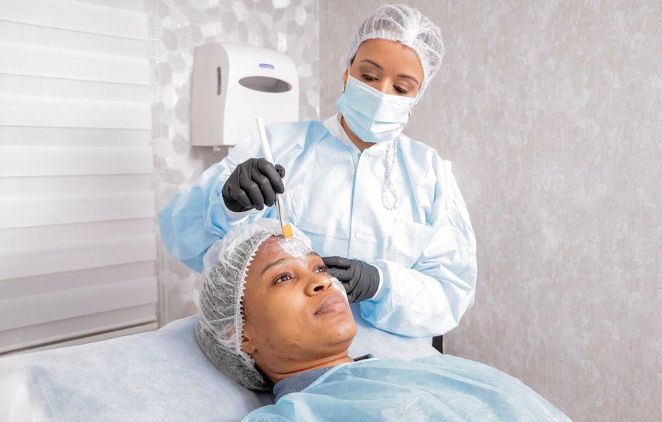 chemical peel treatment